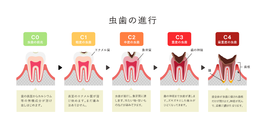 虫歯の進行