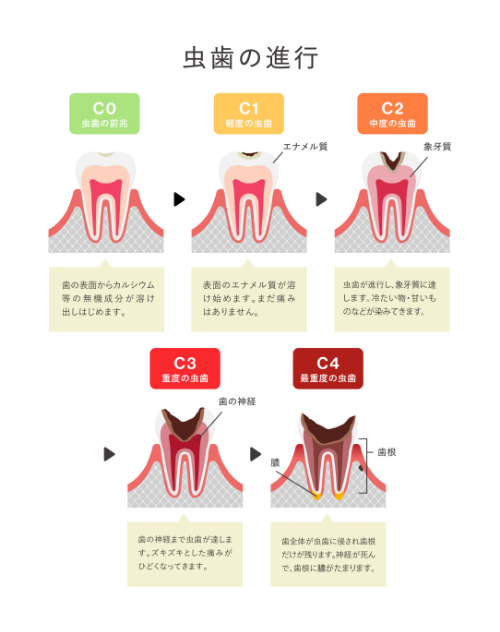 虫歯の進行