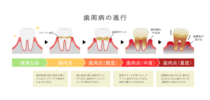 歯周病の進行