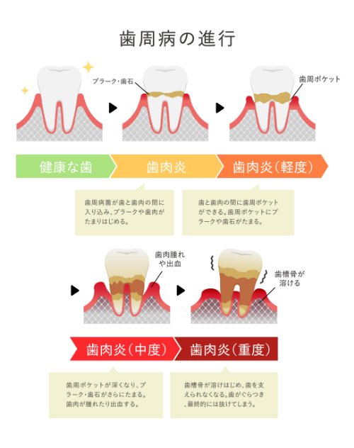 歯周病の進行